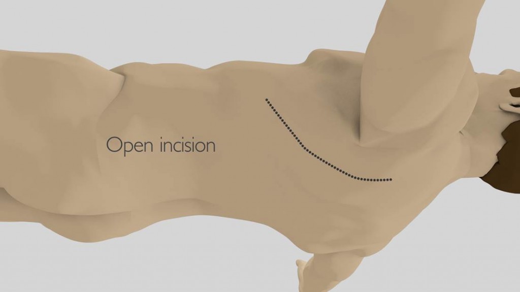 Lobectomy | Thoracic Surgery University Hospitals Birmingham