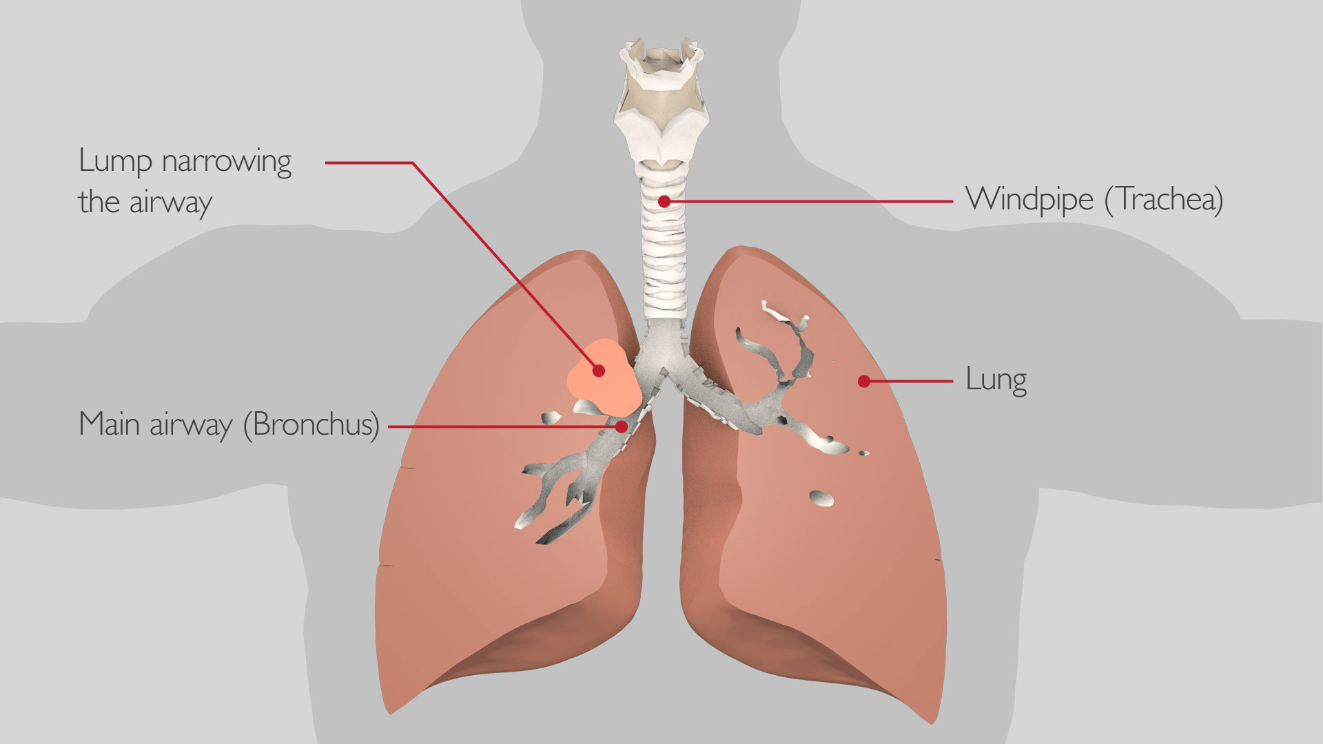 bronchoscopy_stent_1_v2