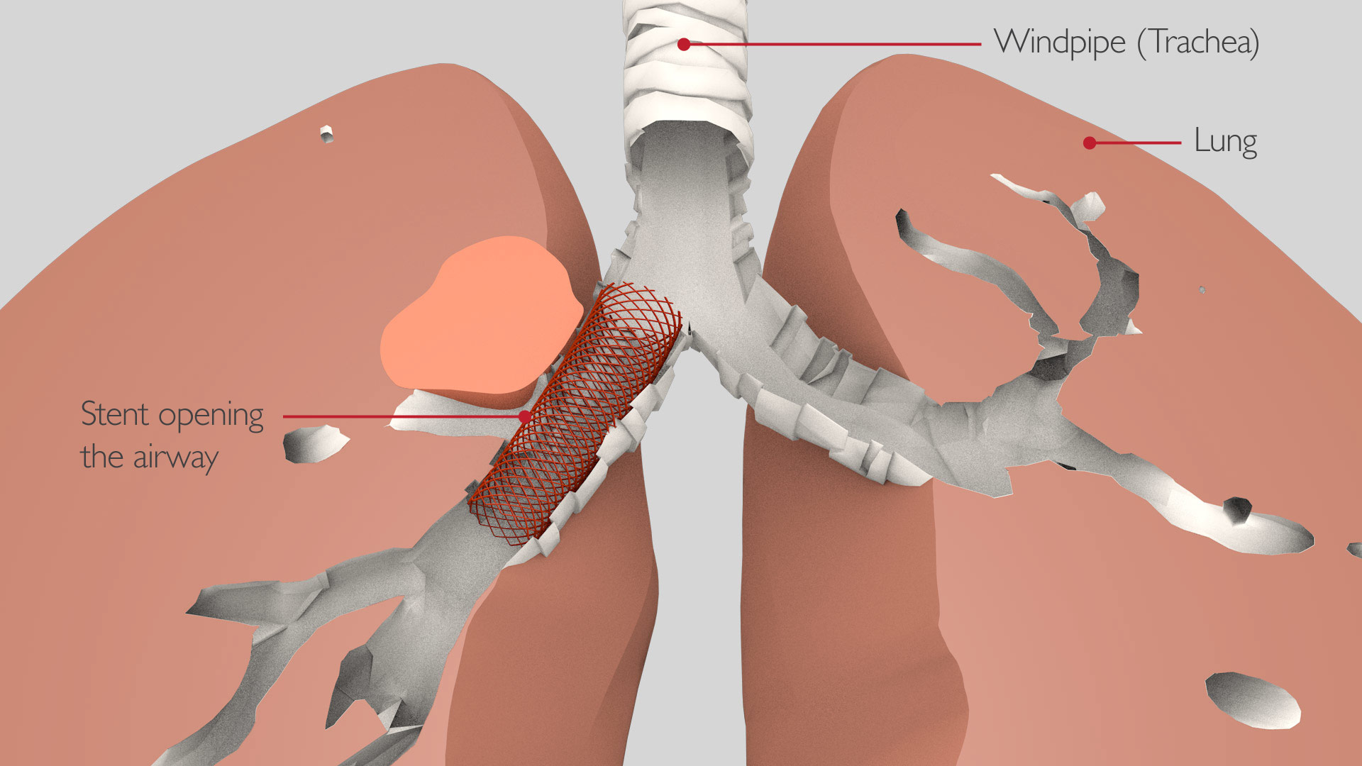 bronchoscopy_stent_2_v2