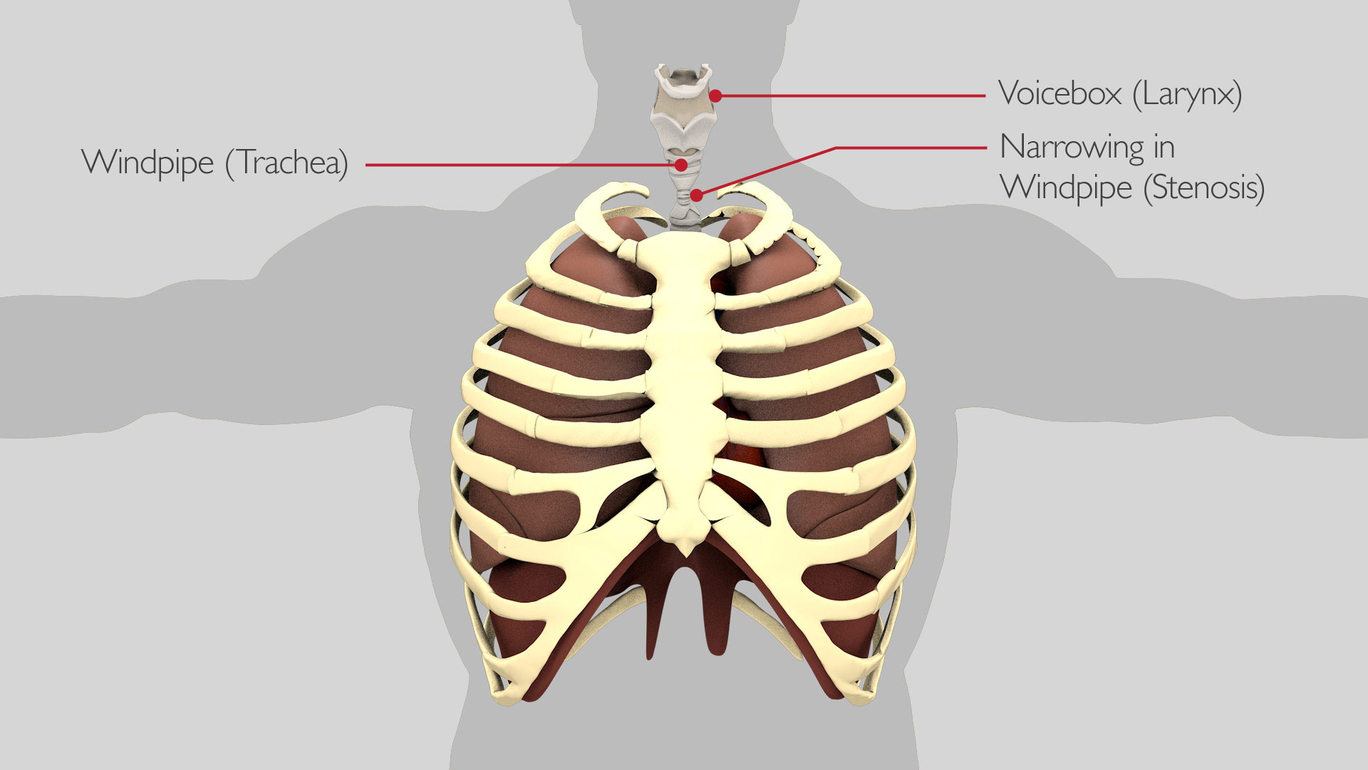 tracheal_resection_1_v2