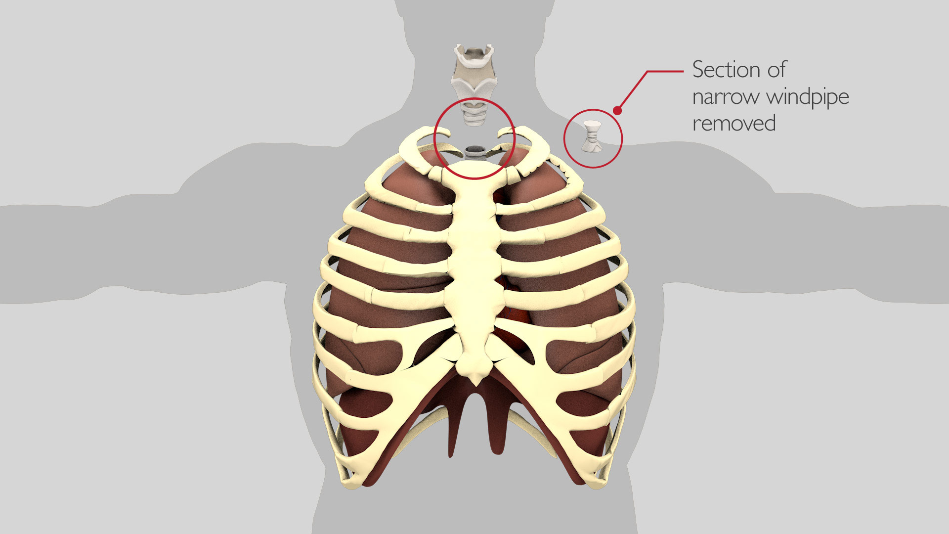 tracheal_resection_2_v2