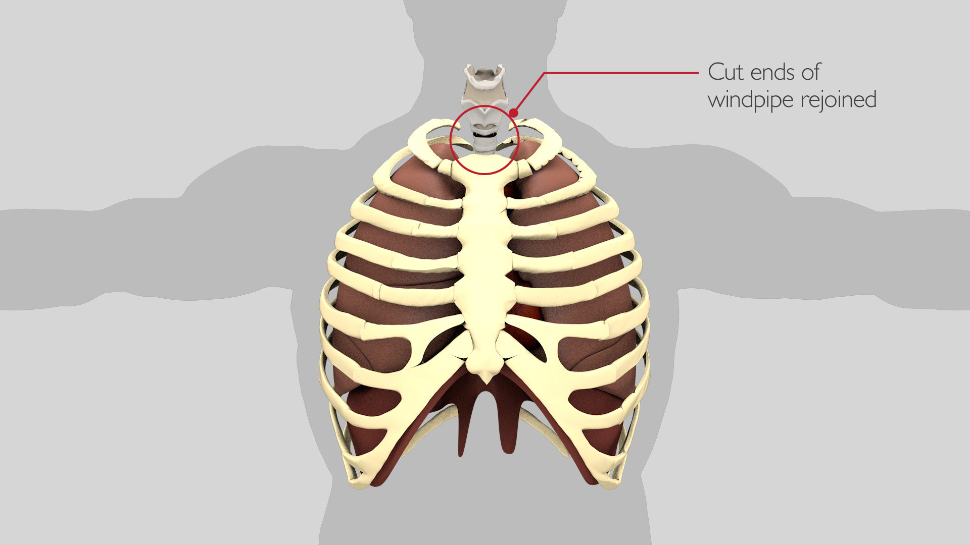 tracheal_resection_3_v2